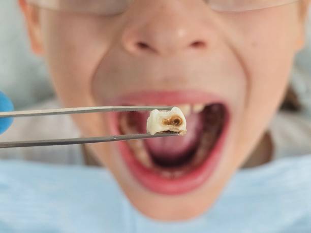 Best Emergency Gum Treatment in Yountville, CA