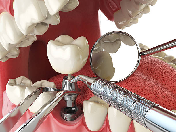 Best Emergency Root Canal Treatment in Yountville, CA