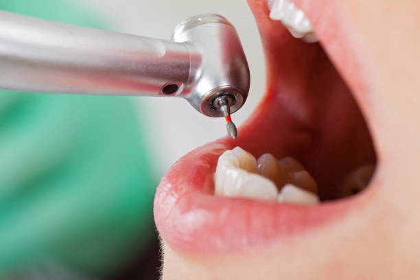 Best Emergency Tooth Extraction in Yountville, CA